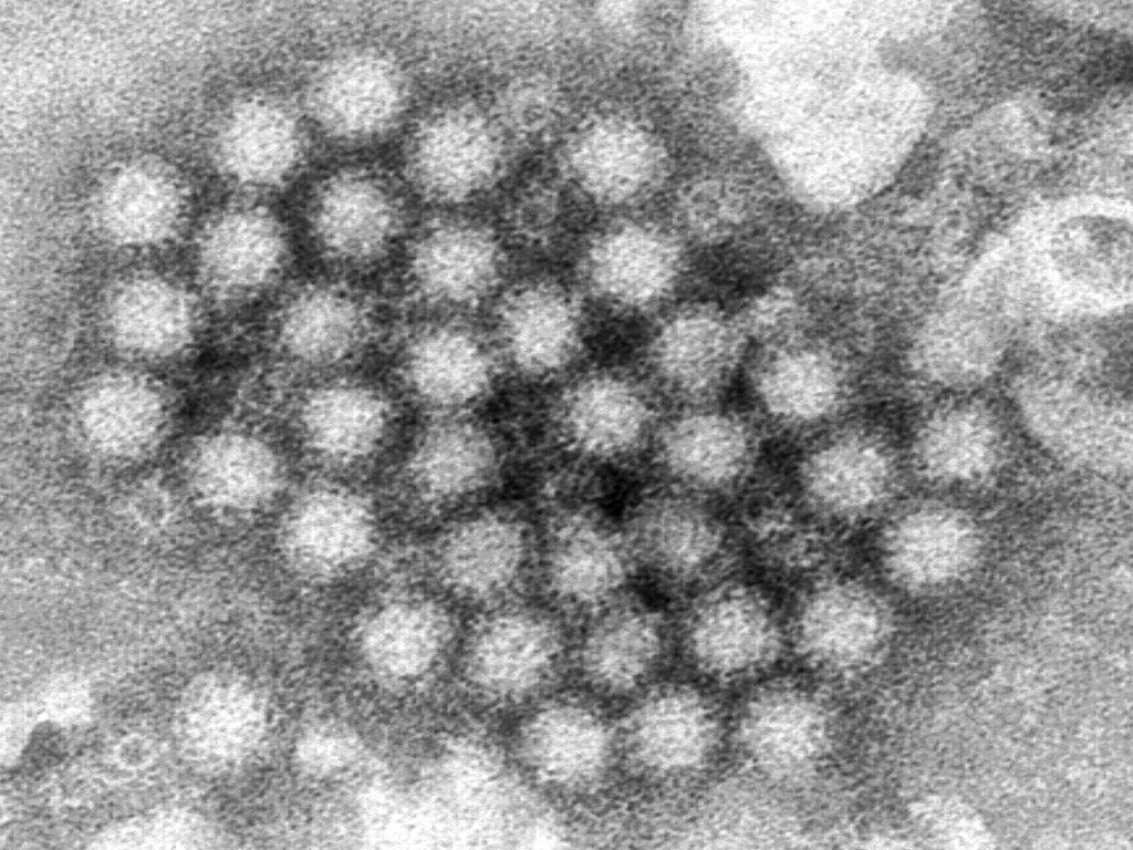 Norovirus melonjak di AS: Apa yang perlu kita ketahui? | Berita Kesehatan